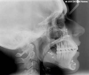 Marie-Hélène Cyr - Cephalometric X-ray after the orthodontic treatments (February 10, 2009)